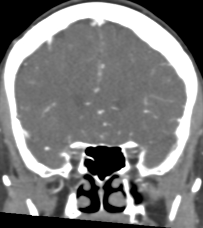 Basilar tip aneurysm with coiling (Radiopaedia 53912-60086 B 46).jpg