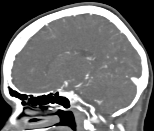 Basilar tip aneurysm with coiling (Radiopaedia 53912-60086 C 52).jpg