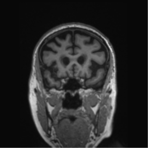 Behavioral variant frontotemporal dementia and late onset schizophrenia (Radiopaedia 52197-58083 Coronal T1 64).png