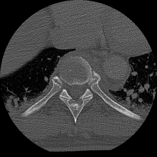 Benign post-traumatic pseudopneumoperitoneum (Radiopaedia 71199-81495 Axial bone window 127).jpg