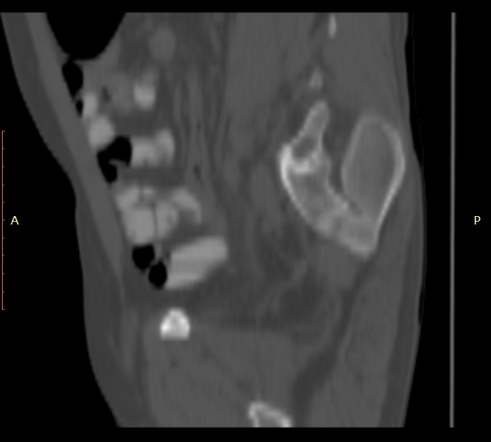 Bertolotti syndrome (Radiopaedia 58974-66235 Sagittal bone window 47).jpg