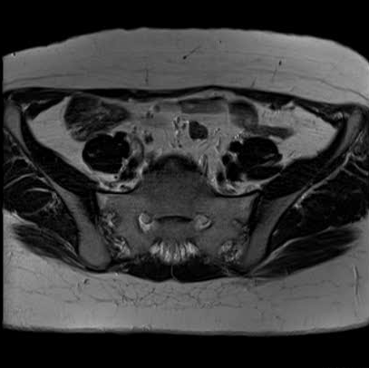 File:Bicornuate uterus (MRI) (Radiopaedia 49206-54297 Axial 35).png
