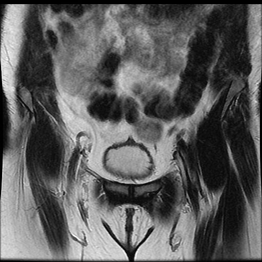 File:Bicornuate uterus (Radiopaedia 51676-57472 Coronal T2 7).jpg