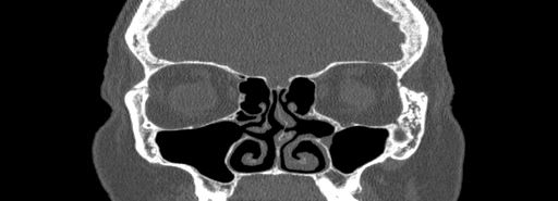 Bilateral Ectopic Infraorbital Nerves (Radiopaedia 49006-54084 Coronal bone window 28).jpg