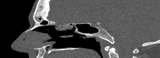 Bilateral Ectopic Infraorbital Nerves (Radiopaedia 49006-54084 Sagittal bone window 27).jpg
