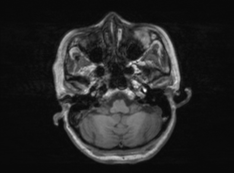 Bilateral PCA territory infarction - different ages (Radiopaedia 46200-51784 Axial T1 318).jpg