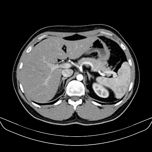 File:Bilateral accessory renal arteries with mild pelvi-ureteric junction (PUJ) obstruction (Radiopaedia 66357-75596 A 12).jpg