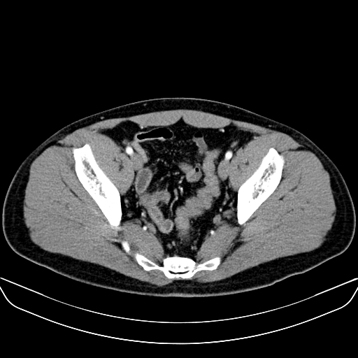 Bilateral accessory renal arteries with mild pelvi-ureteric junction (PUJ) obstruction (Radiopaedia 66357-75596 A 61).jpg