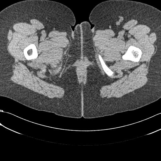 Bilateral acetabular protrusion with pincer type femoro-acetabular impingement (Radiopaedia 30134-30733 AXIAL SOFT THIN 115).jpg