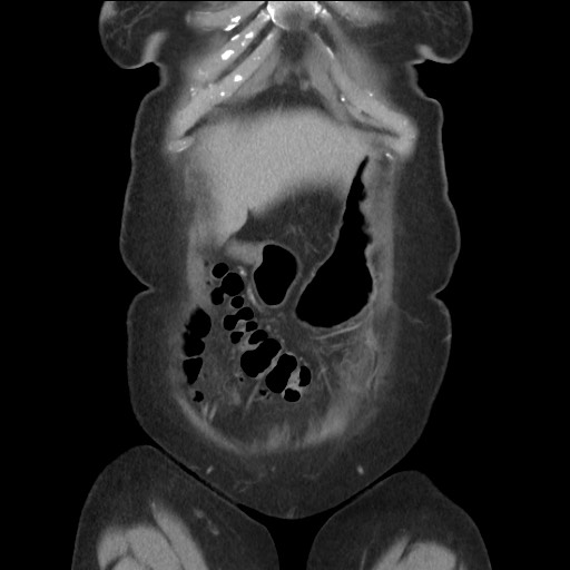 Bilateral adrenal granulocytic sarcomas (chloromas) (Radiopaedia 78375-91007 B 20).jpg