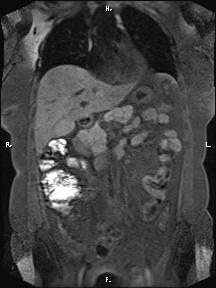 Bilateral adrenal myelolipoma (Radiopaedia 63058-71537 Coronal T1 fat sat 66).jpg