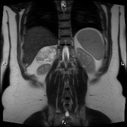 File:Bilateral adrenal myelolipoma (Radiopaedia 63058-71537 Coronal T2 5).jpg