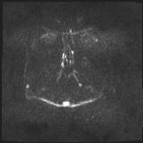 Bilateral basal ganglia and thalamic T1 hyperintensities (Radiopaedia 19764-19802 Axial DWI 20).jpg
