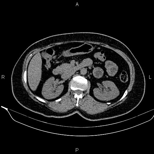 Bilateral benign adrenal adenomas (Radiopaedia 86912-103124 Axial non-contrast 47).jpg