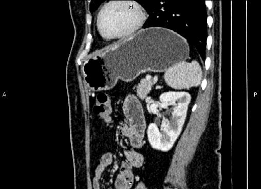 Bilateral benign adrenal adenomas (Radiopaedia 86912-103124 E 71).jpg