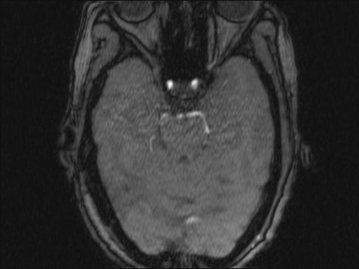 Bilateral carotid body tumors and right glomus jugulare tumor (Radiopaedia 20024-20060 Axial MRA 331).jpg