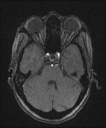 Bilateral carotid body tumors and right glomus jugulare tumor (Radiopaedia 20024-20060 Axial MRA 56).jpg