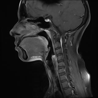 File:Bilateral carotid body tumors and right jugular paraganglioma (Radiopaedia 20024-20060 Sagittal 10).jpg