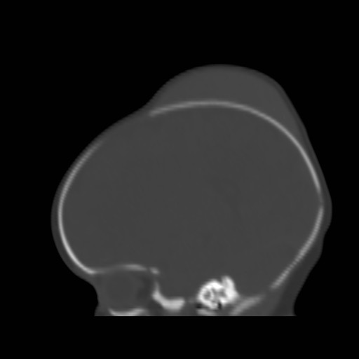 File:Bilateral cephalohematomas and subdural hematomas (Radiopaedia 26778-26929 Sagittal bone window 14).jpg