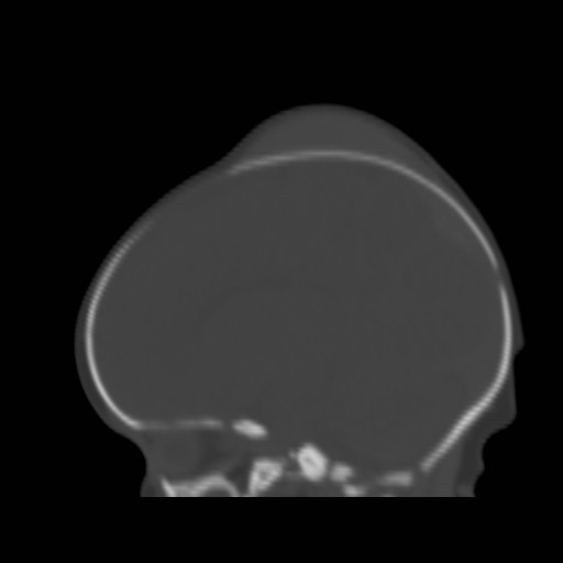 File:Bilateral cephalohematomas and subdural hematomas (Radiopaedia 26778-26929 Sagittal bone window 26).jpg