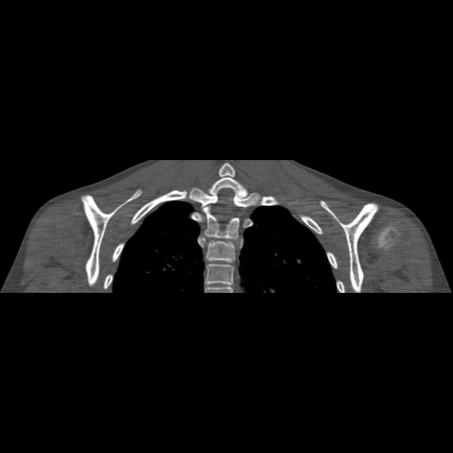 Bilateral chronic posterior shoulder dislocation (Radiopaedia 39213-41452 Coronal bone window 42).jpg