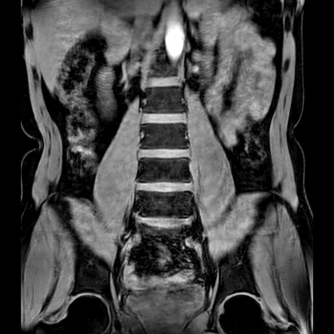 Bilateral conjoined nerve roots at different levels (Radiopaedia 73312-84063 Coronal WE 17).jpg