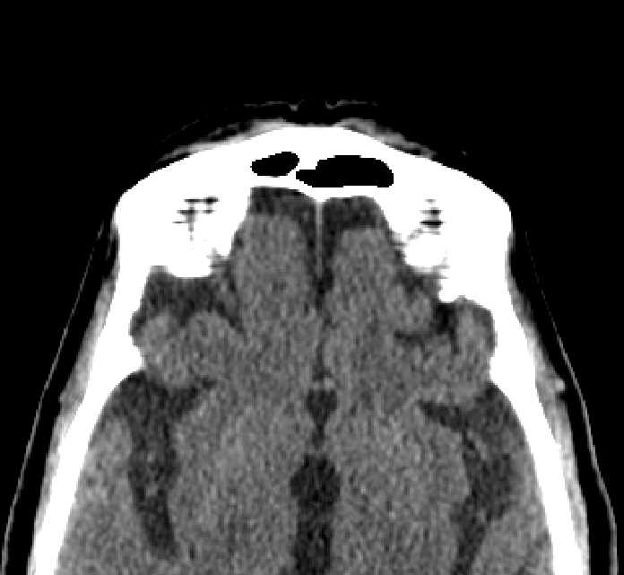 Bilateral ectopia lentis (Radiopaedia 89889-107013 Axial non-contrast 3).jpg