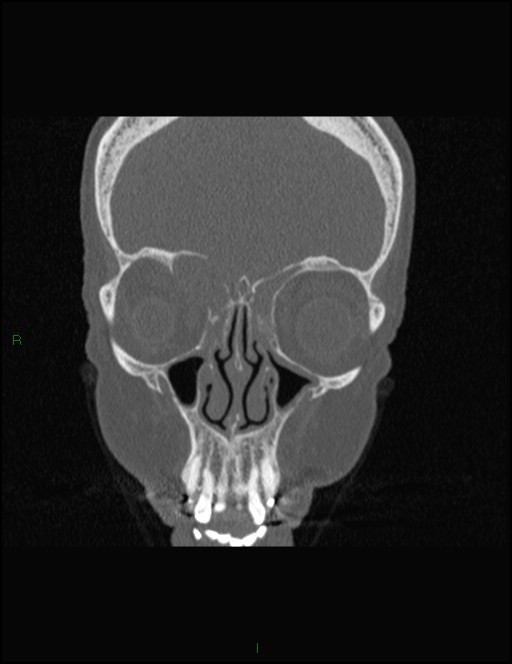 Bilateral frontal mucoceles (Radiopaedia 82352-96454 Coronal 110).jpg