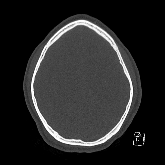 Bilateral occipital condyle fracture (type 2) (Radiopaedia 87675-104089 Axial bone window 99).jpg