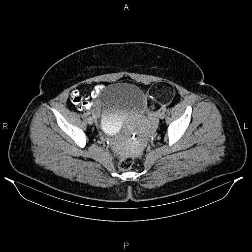 File:Bilateral ovarian dermoid cysts (Radiopaedia 85785-101603 Axial C+ delayed 72).jpg