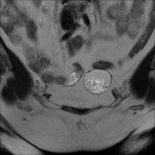 File:Bilateral ovarian dermoid cysts (Radiopaedia 90152-107338 Coronal T2 6).jpg
