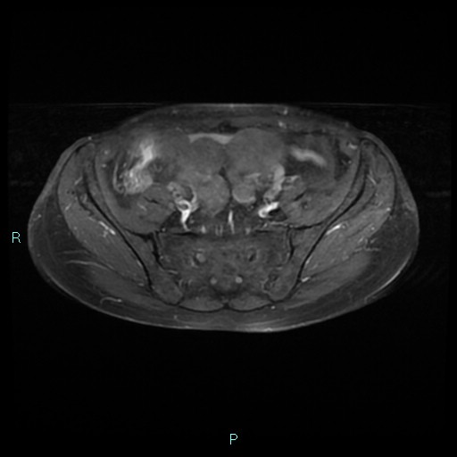 File:Bilateral ovarian fibroma (Radiopaedia 44568-48293 Axial T1 C+ fat sat 7).jpg