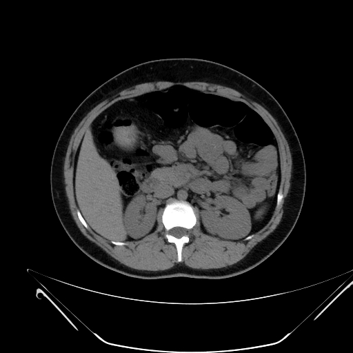 File:Bilateral ovarian mature cystic teratomas (Radiopaedia 79373-92457 Axial non-contrast 17).jpg