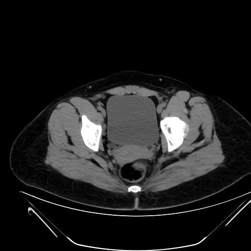 Bilateral ovarian mature cystic teratomas (Radiopaedia 79373-92457 Axial non-contrast 76).jpg