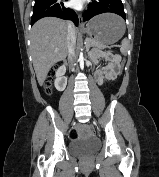 Bilateral ovarian mature cystic teratomas (Radiopaedia 79373-92457 B 42).jpg