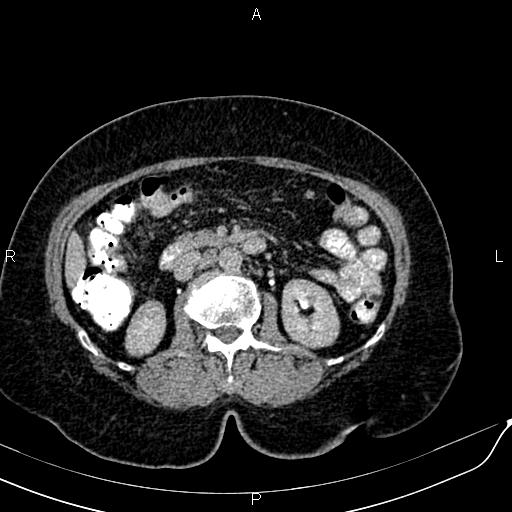 Bilateral ovarian serous cystadenocarcinoma (Radiopaedia 86062-101989 Axial C+ delayed 27).jpg