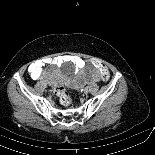 Bilateral ovarian serous cystadenocarcinoma (Radiopaedia 86062-101989 Axial C+ delayed 62).jpg