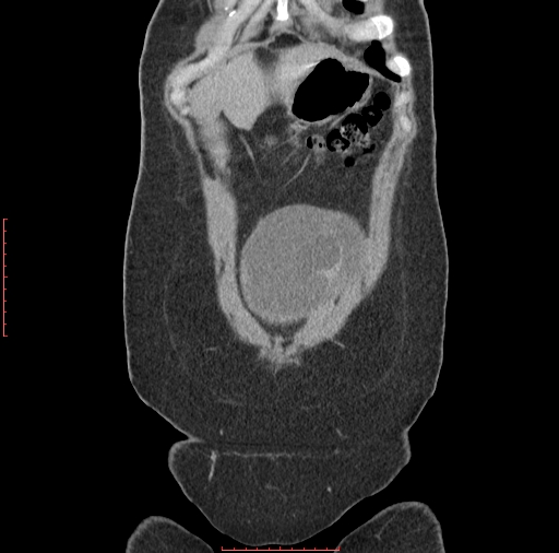 File:Bilateral ovarian serous cystadenocarcinoma with right ovarian torsion (Radiopaedia 32640-33611 B 3).jpg