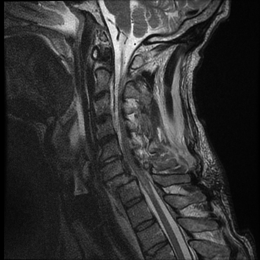 File:Bilateral perched facets with cord injury (Radiopaedia 45587-49714 Sagittal T2 6).jpg