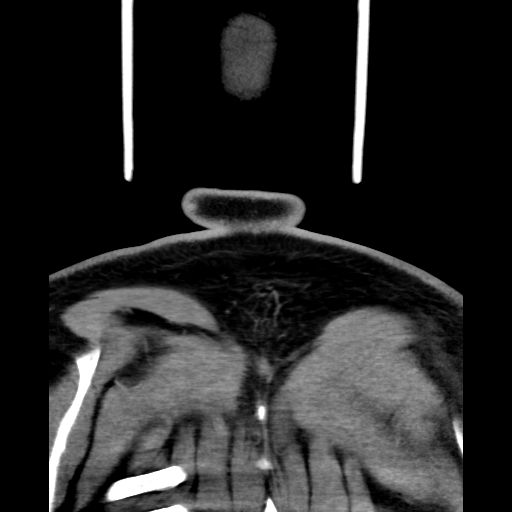 Bilateral peritonsillar abscess (Radiopaedia 85065-100610 Coronal 74).jpg