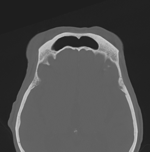 File:Bilateral preseptal periorbital cellulitis (Radiopaedia 43081-46350 Axial bone window 9).png