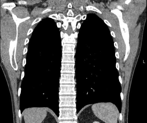 Bilateral pulmonary AVM (Radiopaedia 83134-97505 C 57).jpg
