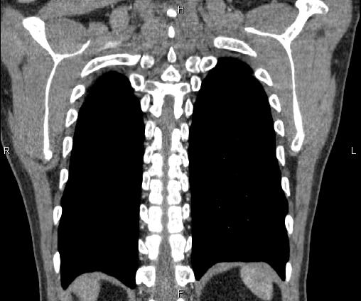 Bilateral pulmonary AVM (Radiopaedia 83134-97505 C 62).jpg
