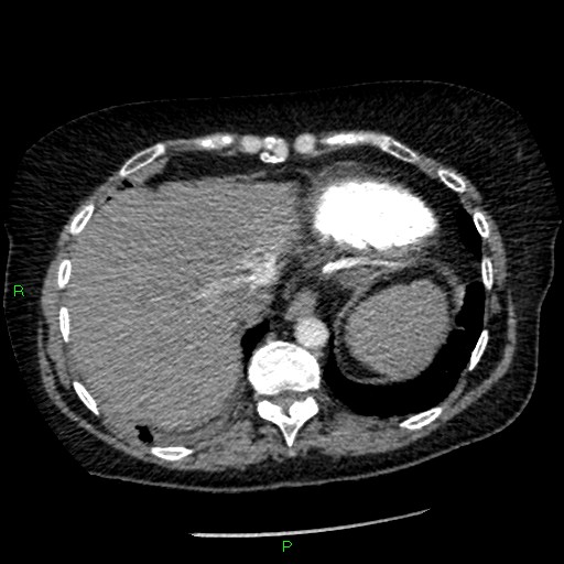Bilateral pulmonary emboli (Radiopaedia 32700-33669 Axial C+ CTPA 92).jpg