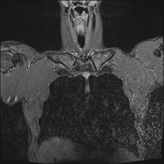 File:Bilateral spinoglenoid notch ganglion cysts (Radiopaedia 29577-30082 Coronal STIR 5).jpg