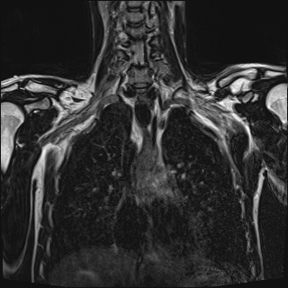File:Bilateral spinoglenoid notch ganglion cysts (Radiopaedia 29577-30082 Coronal T2 52).jpg
