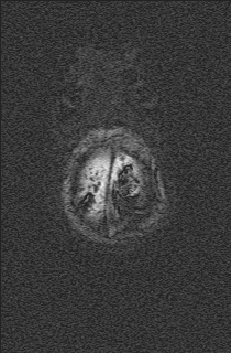 File:Bilateral subdural hemorrhage and parietal skull fracture (Radiopaedia 26058-26190 Axial SWI 79).png