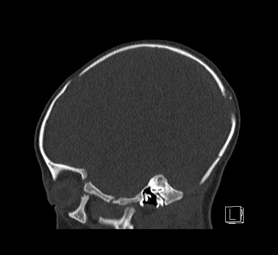 Bilateral subdural hemorrhage and parietal skull fracture (Radiopaedia 26058-26192 Sagittal bone window 22).png