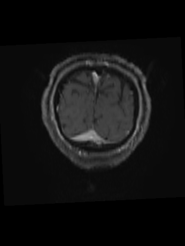 File:Bilateral thalamic glioma (Radiopaedia 65852-75009 Coronal T1 C+ 24).jpg