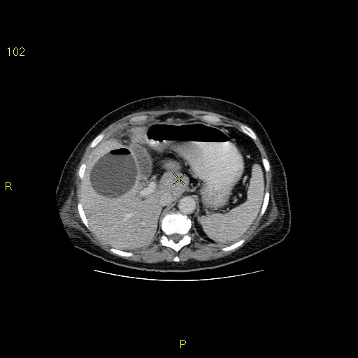 File:Biloma with drainage into the colon (Radiopaedia 20032-20068 A 10).jpg